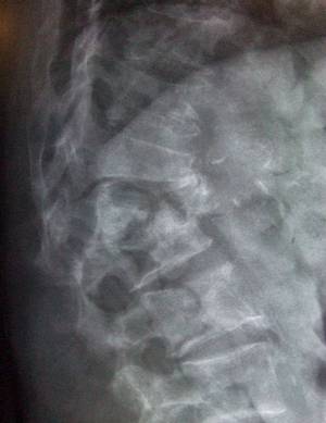 Osteoporosis spinal fracture